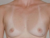 Patient # 13100 Before Photo # 1